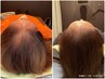 育毛促進・ボリューム増・髪活【幹細胞ダーマ鍼による最新施術】6ヶ月コース