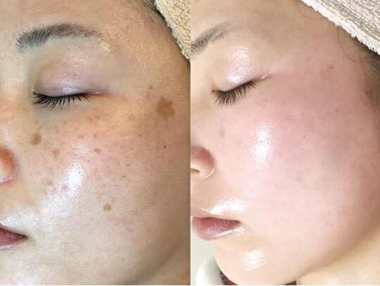 茨木市でダイヤモンドピーリングが人気のエステサロン｜ホットペッパー