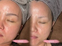 ソア(Soa)/肌質改善×リフトアップ＊