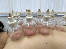 船橋ウィメンズ鍼灸院/カッピング施術イメージ