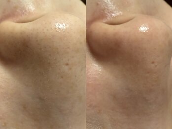 リボーン(REBORN)/毛穴ケア