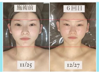 千歳の女神 三河安城店/【施術風景】Before/After