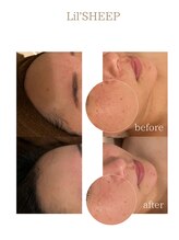 リルシープ(LIL'SHEEP)/REVI陶肌ピール