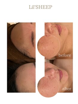 リルシープ(LIL'SHEEP)/REVI陶肌ピール