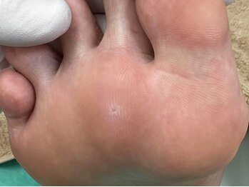 ディオフット(DIO FOOT)の写真/【国内トップクラスの施術実績】経験豊富な知識と確かな技術力で[巻き爪/分厚い爪]も改善◎