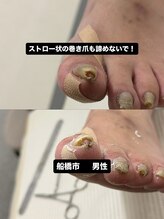 巻き爪じゅん 千葉駅前店/限界の巻き爪でも諦めないで