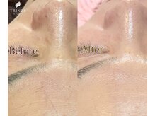 トリンテ バイ フェース(TRINTE by FAITH)/【ララピール】2回(2週間隔）