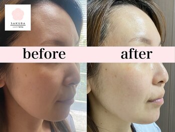 サクラ(SAKURA)/エアバリ1回体験