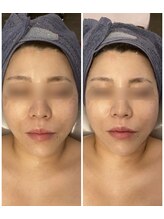 小顔コルギサロン シー(She)/【コルギ】1度の変化!