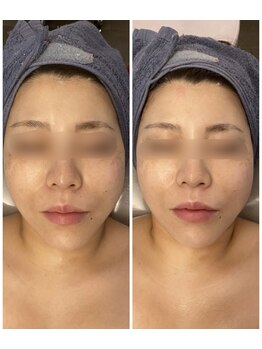 小顔コルギサロン シー(She)/【コルギ】1度の変化!