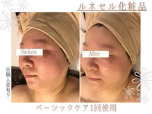 上野エステサロン レア(Lea)/フェイシャル/ハーブピーリング