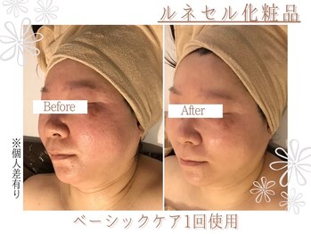 上野エステサロン レア(Lea)/フェイシャル/ハーブピーリング