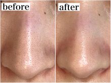 アワピール 成田公津の杜店(AWA PEELL)/ハーブピーリングで毛穴ケア