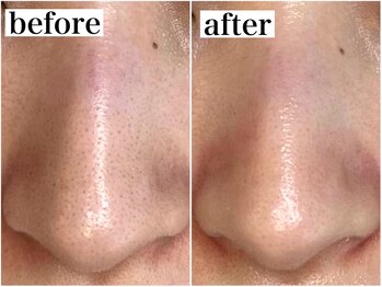 アワピール 成田公津の杜店(AWA PEELL)/ハーブピーリングで毛穴ケア