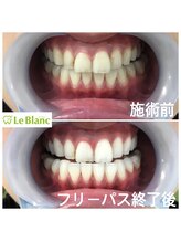 ルブラン 奈良店(Le Blanc)/頑張って通って白く！！