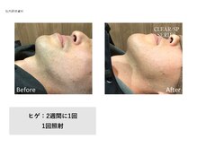 フェレザ 新潟(Felleza)/ヒゲ脱毛で若見え効果も