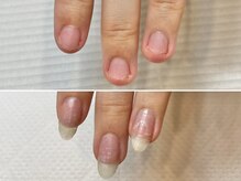 グラシュータン(gracieux temps)/深爪矯正