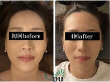 キュープ 富士店(Qpu)/たった4回で別人級！！/富士市