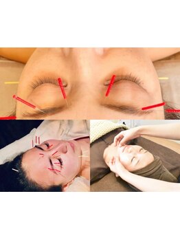 鍼灸施術を受けたい