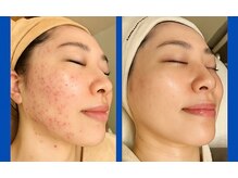 アンナビューティーサロン 博多店の雰囲気（【ニキビケア】ニキビや肌荒れでお悩みの方におすすめ）