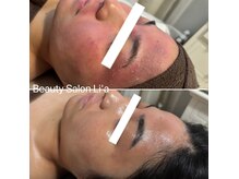 お肌に合わせて最適なメニューをご提案します。