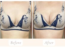 ノルン(Norn)/40代育乳バストアップ（5回目）