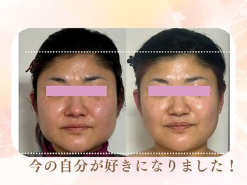 美カナエル(美kanaeru)/鼻筋とフェイスライン