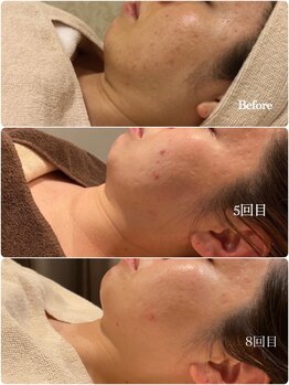 ルーヴェ(Luve)/陶肌トリートメント