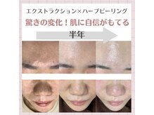 サロン リュンヌ(salon lune)/エクストラクション＋ピーリング