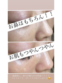 トイボーテ(toi beaute)/毛穴のお悩み解決します！！