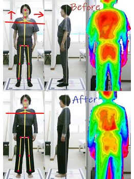 姫路なごみ整体院 なごみ鍼灸院/改善例（右尻と右下肢の痛み）