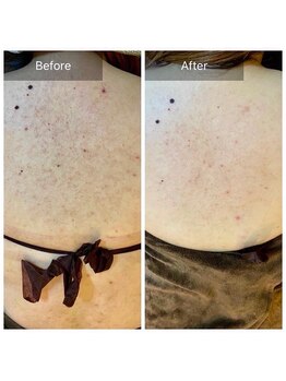 ビビ(VIVI)/背中ニキビケアハーブピーリング