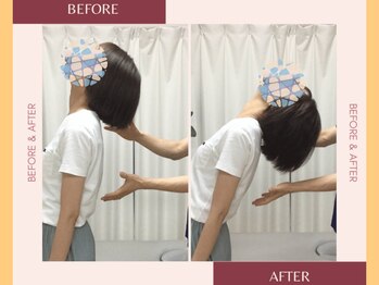 整体院 來花 福岡薬院店(KOHANA)/Bifo/Afuta 1（反り腰・猫背）