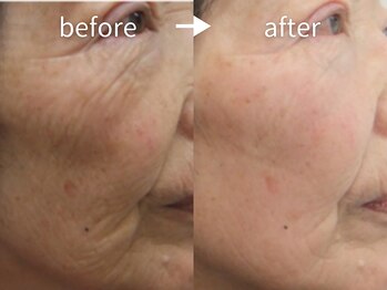 アルカンシエル(arcenciel)/コースエイジングケアコース