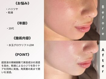 ルディラ医療提携エステ 立川店 毛穴/小顔/ニキビ・シミ・美白・シワ・たるみケア/水玉グロウリフト(韓国式LDM)