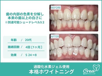 クレア(Crea)/【ホワイトニング症例写真】