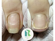 レイ(Ray)/最新技術の巻き爪ケア