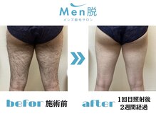 メン脱(Men脱)/★ビフォーアフター★