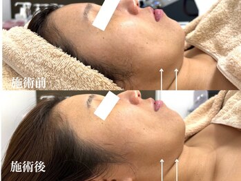 キーオブフェイス(Key of Face)/お悩み【フェイスラインたるみ】