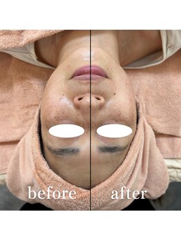 ミュー 春日井店(mieux)/◆肌質改善例