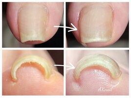 巻き爪補正親指