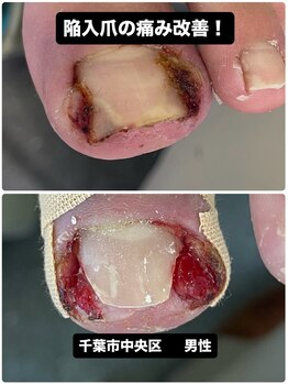 巻き爪じゅん 千葉駅前店/千葉市中央区で陥入爪に悩む方へ