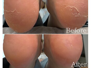 カシェット 広島店(Cachette)/20代女性☆足裏角質ケア90分