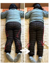 はあと/足のねじれ改善