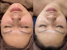 アドビューティ(Add Beauty)/≪小顔リフト／シワたるみ改善≫