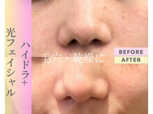 Cスキンケアクリニック 麻布店/ハイドラ+光フェイシャル