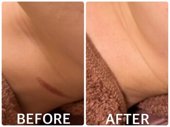 ハーブピーリング 恵比寿/ハーブピーリング