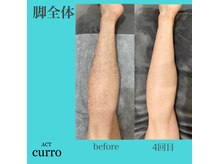 アクト クロ(ACT curro)/【脚全体】脱毛施術例