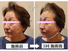 パールリフト 小田原店/頭皮から背中の筋膜を緩める