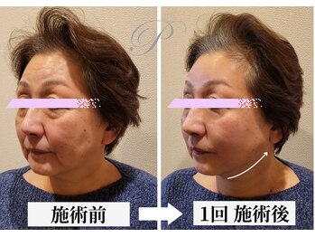 パールリフト 小田原店/頭皮から背中の筋膜を緩める